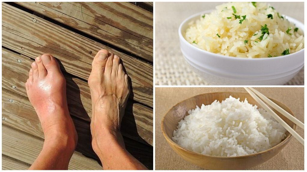 Chế độ ăn kiêng từ gạo được khuyến khích cho bệnh nhân gút. 